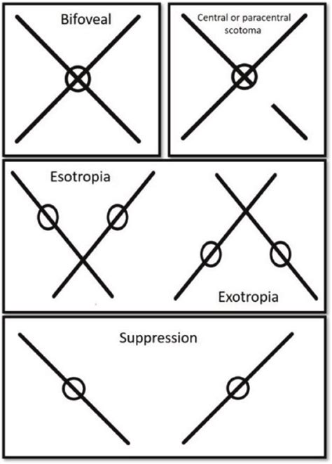 bagolini test.
